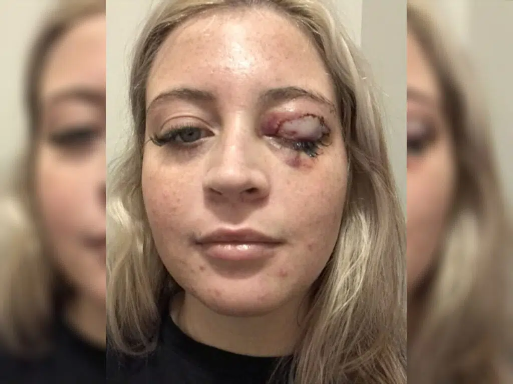 The incident where a Chihuahua rips off eyelid of a girl, shown by an image of the victim
